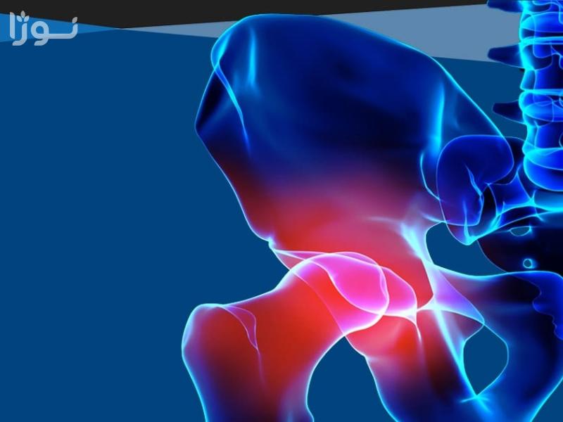 شکستگی لگن؛ علل، علائم، تشخیص و روش‌های درمان 