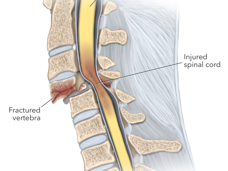 انواع آسیب نخاعی + بررسی علائم و مدیریت و درمان آن