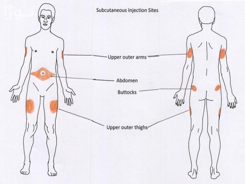 محل تزریق زیر جلدی+ تزریق انسولین+ تزریق هپارین