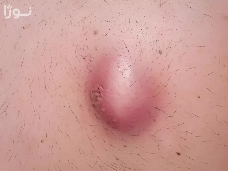آبسه چیست