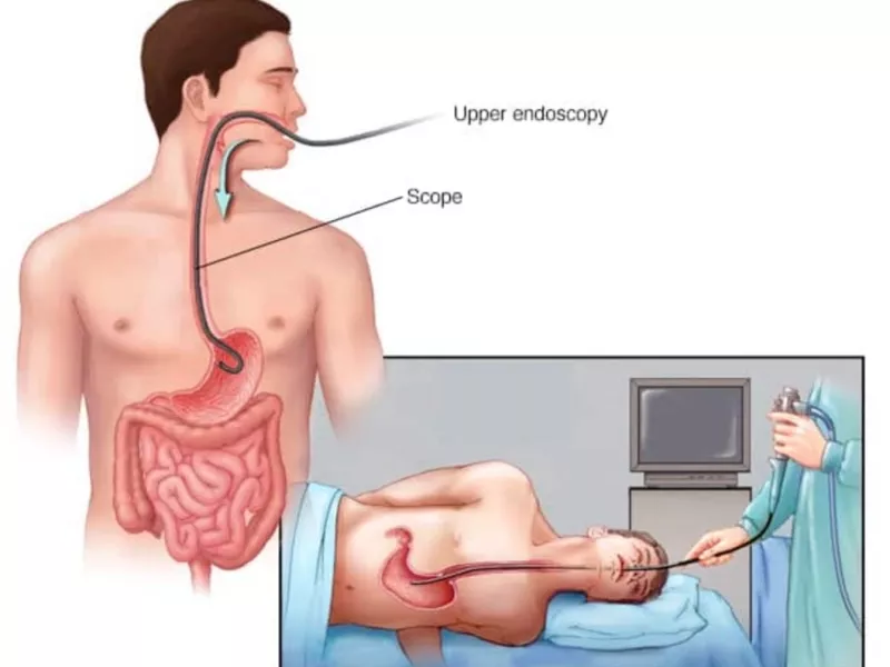 زخم سطحی معده در اندوسکوپی - مرحله ۱ فارست