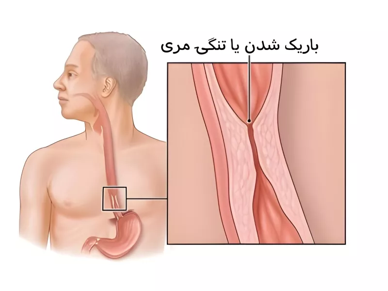 تنگی مری و عوارض خطرناک رفلاکس درمان نشده - ازوفاژیت، مری بارت و سرطان مری