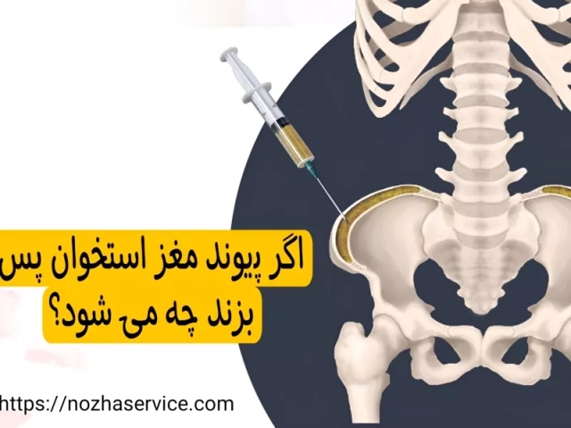 اگر پیوند مغز استخوان پس بزند چه می شود؟